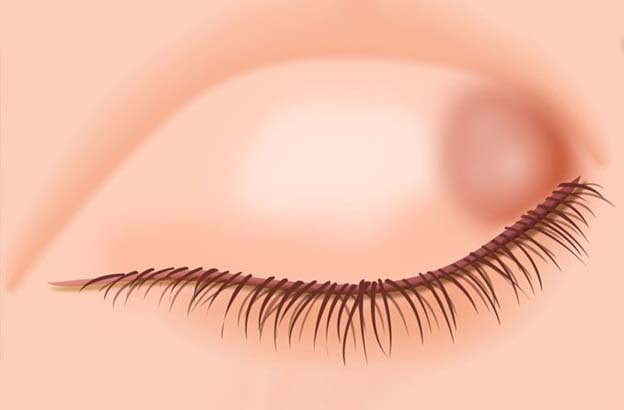 Depiction of Chalazion