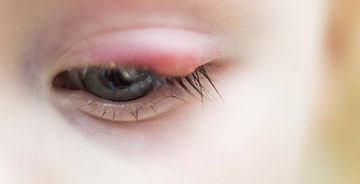 Chalazion: Bump on Eyelid
